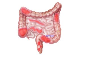 Crohn Hastalığında uçuşa uygunluk