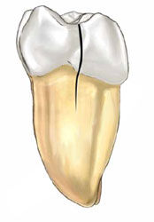 Yüksek İrtifaya Ani Maruz Kalma Sonucu Oluşan Diş Kırıkları