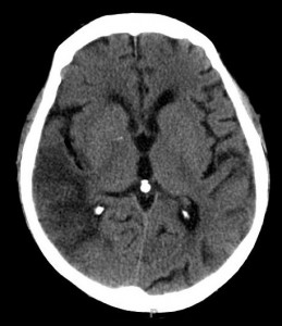 Sivil Pilotta Gaz Embolisi