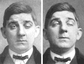 Miyastenia Gravis’li Bir Pilot