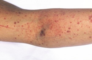 İdiopatik Trombositopenik Purpura